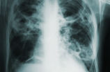 磨玻璃肺部结节是怎么回事(磨玻璃肺部结节是怎么回事？原来是这样！)